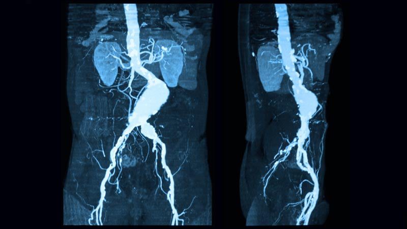 Aneurisma da Aorta Abdominal: Sintomas e Tratamentos Importantes