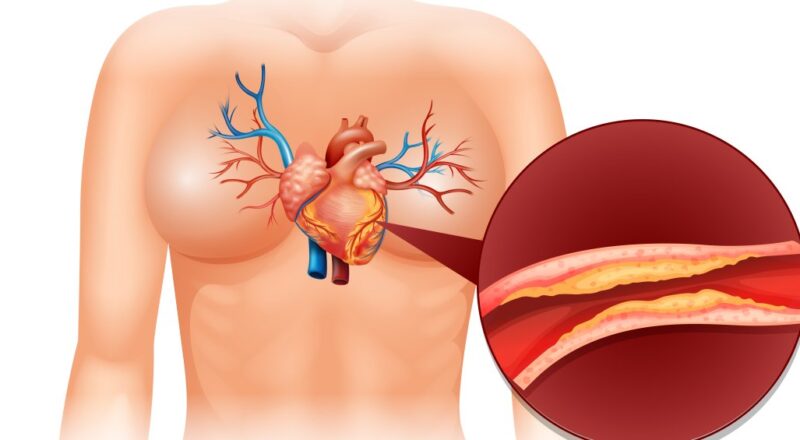 Imagem ilustrativa sobre aterosclerose, mostrando placas nas artérias.