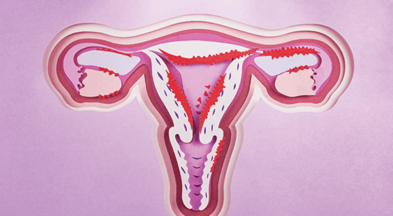 Imagem ilustrativa de endometriomas, cistos ovarianos associados à endometriose