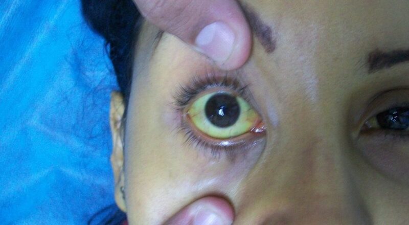 Olhos amarelados indicando icterícia ocular