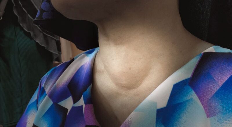 Representação da glândula tireoide em forma de borboleta com destaque para sintomas de hipotireoidismo