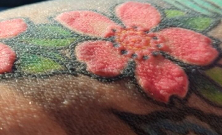 Homem com reações alérgicas após tatuagem vermelha