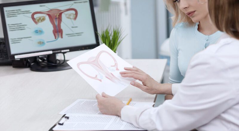 Ilustração mostrando a anatomia do útero com destaque para a adenomiose