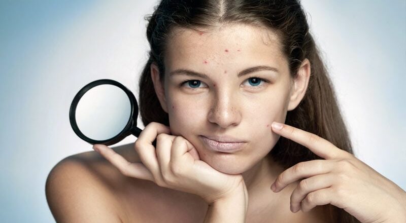 Imagem ilustrativa de pele com acne, mostrando cravos e espinhas em diversos estágios de desenvolvimento.
