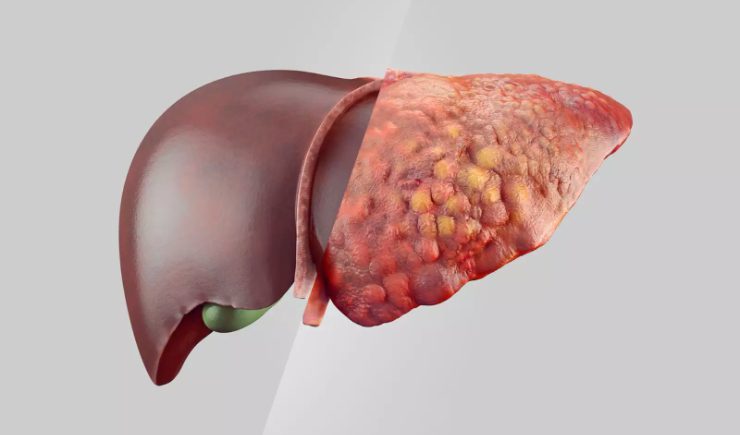 Imagem ilustrativa do medicamento survodutida sendo administrado a pacientes com obesidade e doença hepática