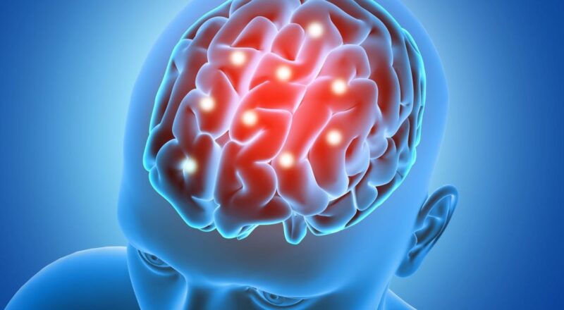 Diagrama ilustrativo da estimulação cerebral profunda destacando a colocação de eletrodos no cérebro e o gerador de impulsos elétricos.