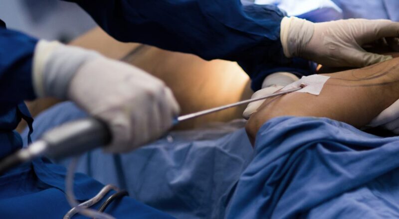 Imagem de um paciente após cirurgia plástica para remoção de excesso de pele após grande perda de peso